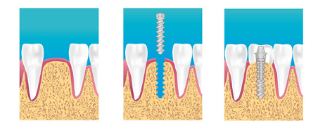 implant dentaire rueil malmaison
